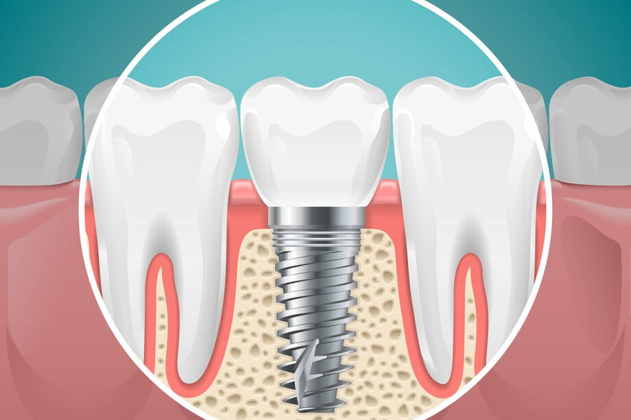 Dental Implant and Crown: Is This Combination Right for You?